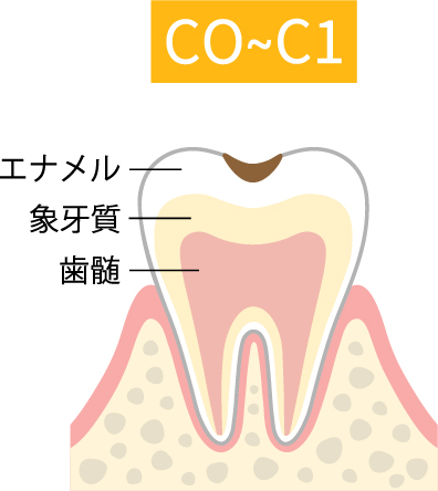 虫歯C0～C1